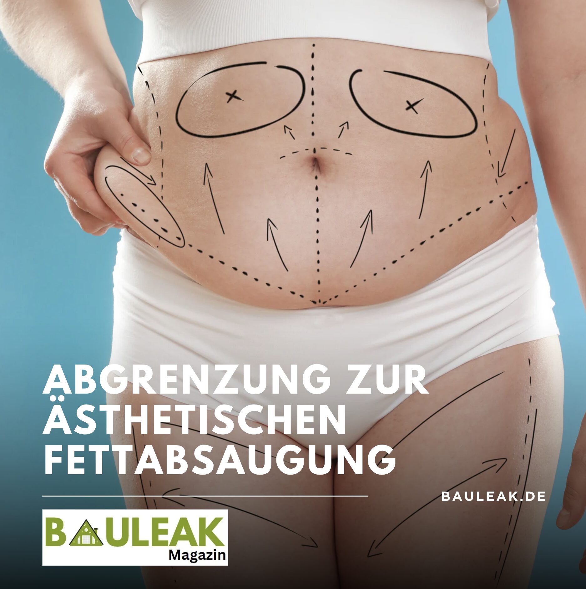 Abgrenzung zur ästhetischen Fettabsaugung liposuktion Abgrenzung zur ästhetischen Fettabsaugung liposuktion